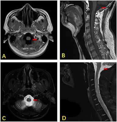 Central nervous system infection caused by Mycobacterium houstonense: A case report